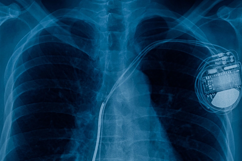 Pacemaker (Image Courtesy: Goodfellow)